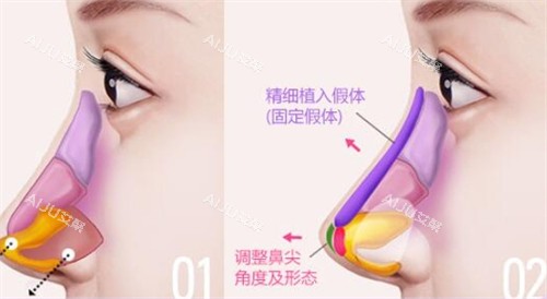 鼻尖假体植入位置