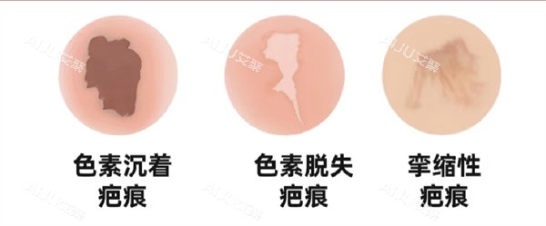 疤痕图片