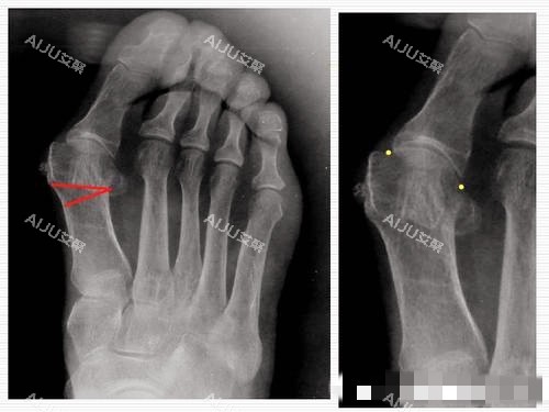 大脚骨X光片图片 大脚骨X光片图片