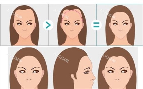 女性m型发际线卡通图 女性m型发际线卡通图