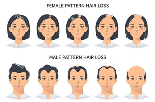 男女生发际线对比 男女生发际线对比