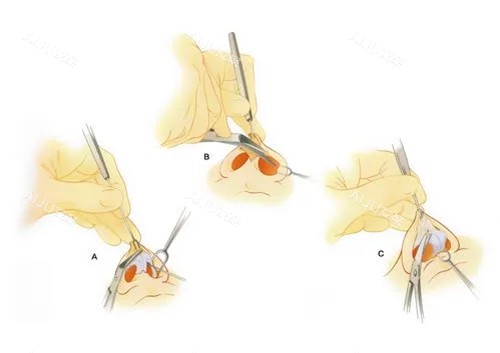 隆鼻整形切口示意图