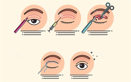 埋线双眼皮过程卡通图 埋线双眼皮过程卡通图